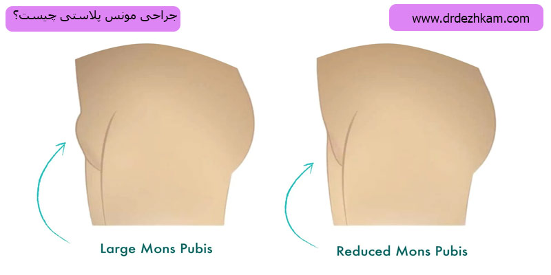 جراحی-مونس-پلاستی
