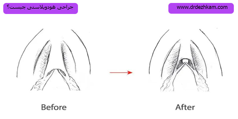 جراحی-هودوپلاستی-چیست؟