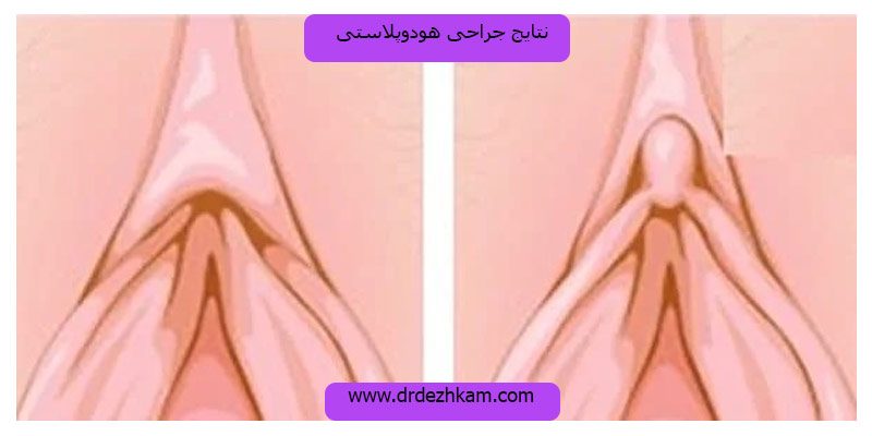 نتایج-جراحی-هودوپلاستی