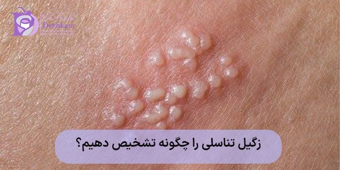 علائم زگیل تناسلی در زنان