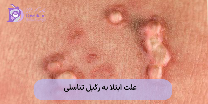 پیشگیری از ابتلا به زگیل تناسلی
