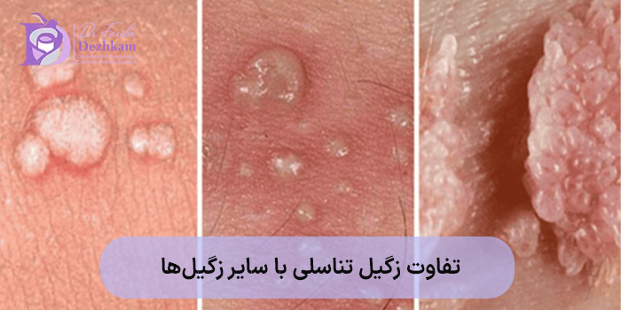 تفاوت زگیل تناسلی با سایر زگیلها