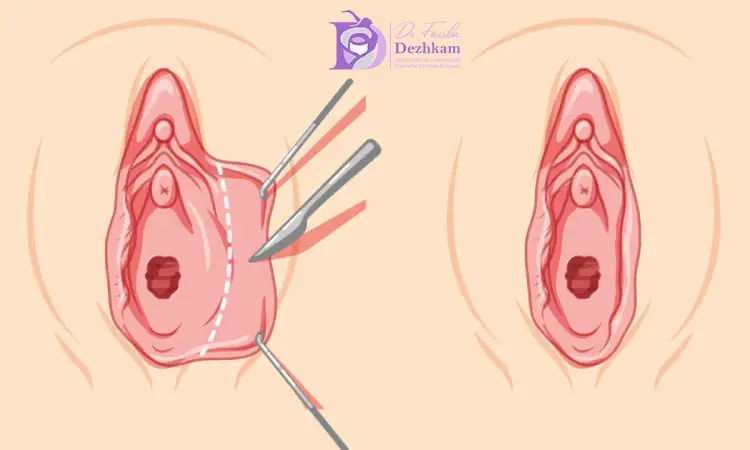 هزینه عمل لابیاپلاستی با لیزر چقدر است؟