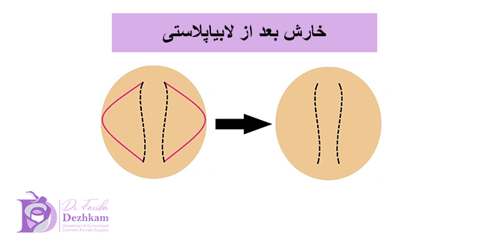 علت خارش بعد از لابیاپلاستی چیست؟