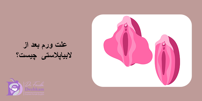 علت ورم بعد از لابیاپلاستی چیست؟