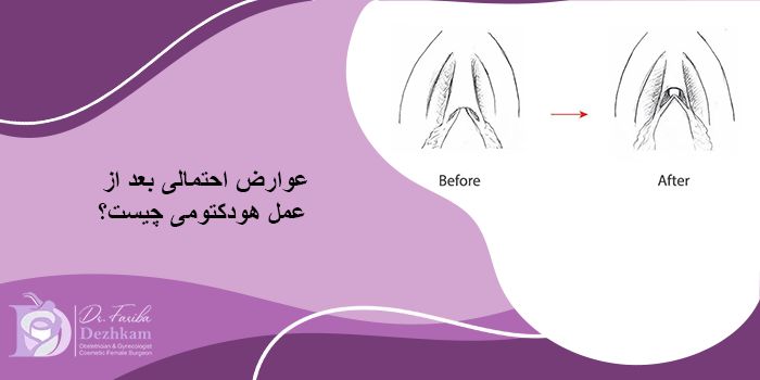 عوارض عمل هودکتومی