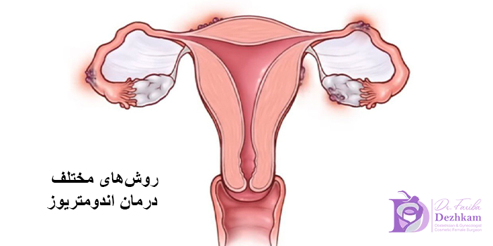 درمان اندومتریوز