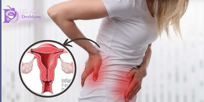 تفاوت آندومتریوز و آدنومیوز در درمان