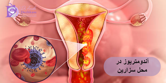 آندومتریوز در محل سزارین