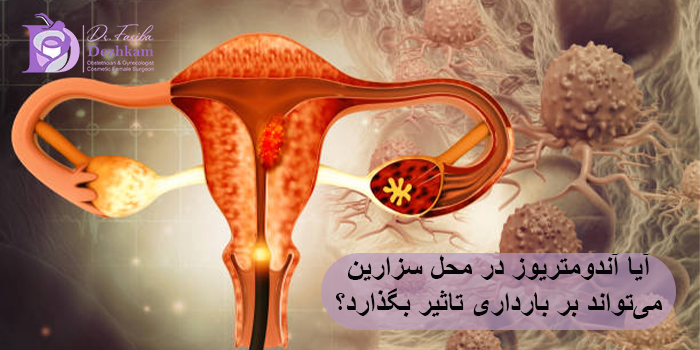 آیا آندومتریوز در محل سزارین میتواند بر بارداری تاثیر بگذارد؟