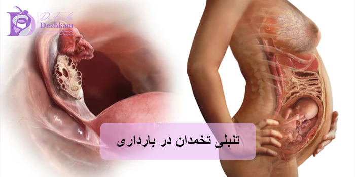 تنبلی تخمدان در بارداری
