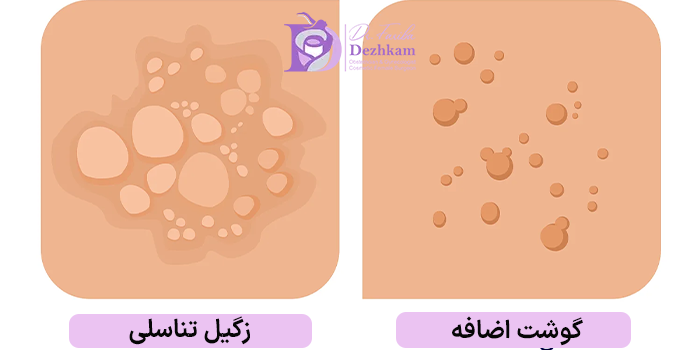 تفاوت گوشت اضافه و زگیل تناسلی