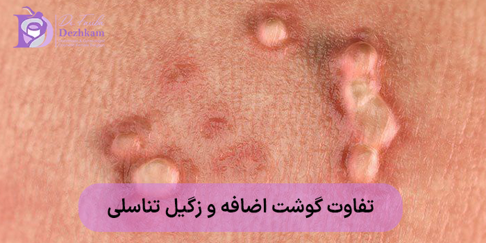 تفاوت گوشت اضافه و زگیل تناسلی از نظر میزان سرایت