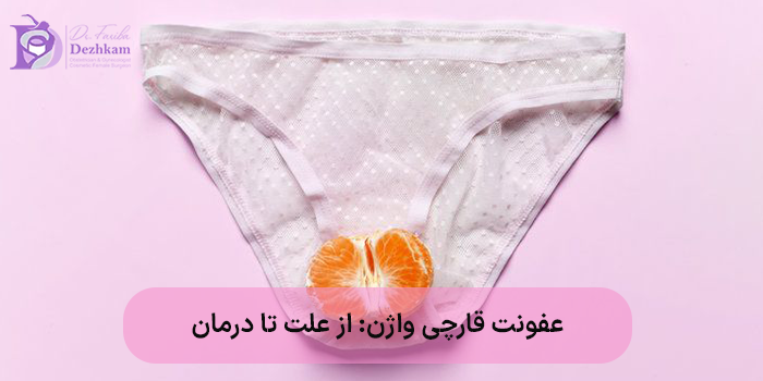 عفونت قارچی واژن