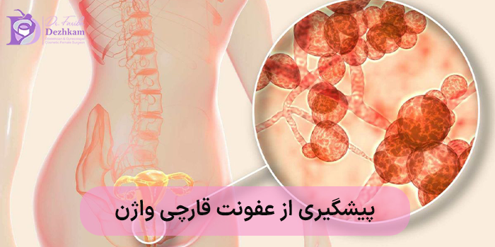 پیشگیری از عفونت قارچی واژن