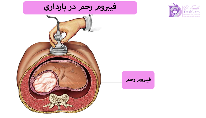 فیبروم رحم در بارداری