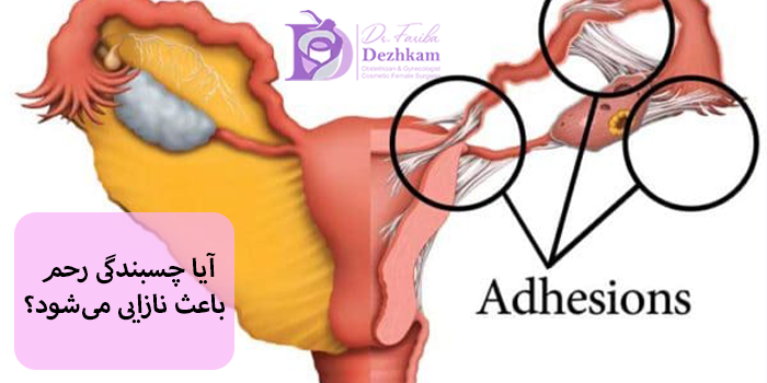 آیا چسبندگی رحم باعث نازایی میشود؟