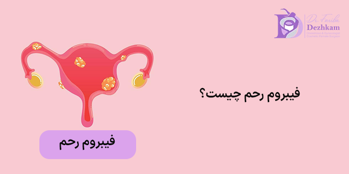 فیبروم رحم