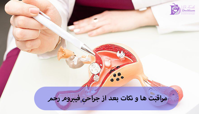 مراقبت ها و نکات بعد از جراحی فیبروم رحم