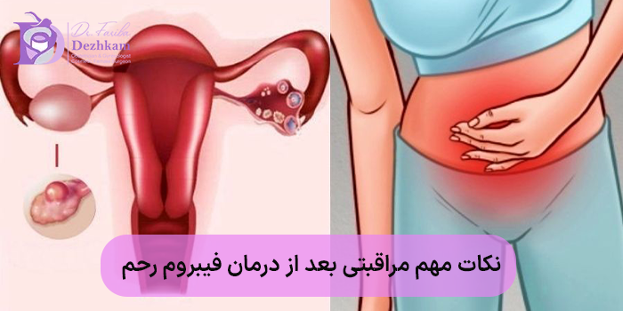 نکات مهم مراقبتی بعد از درمان فیبروم رحم