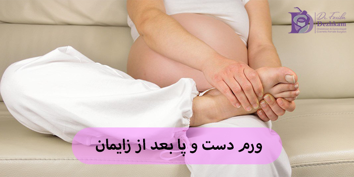 ورم دست و پا بعد از زایمان