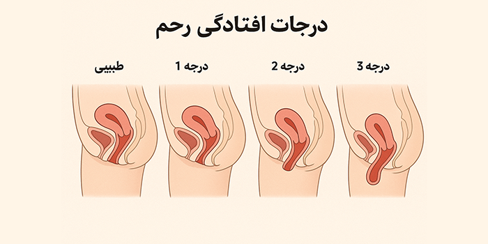 افتادگی رحم