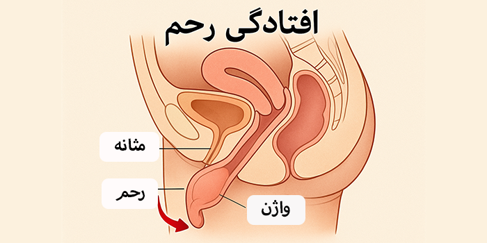 افتادگی رحم