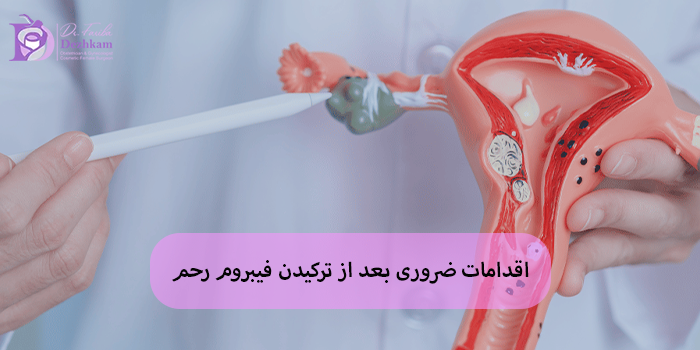 اقدامات ضروری بعد از ترکیدن فیبروم رحم