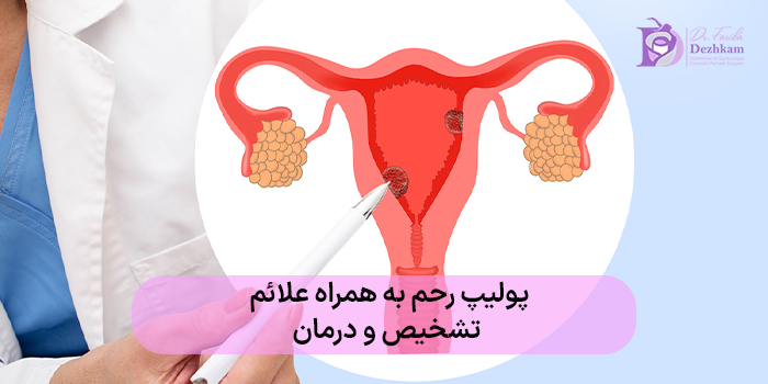 پولیپ رحم + علائم، تشخیص و درمان