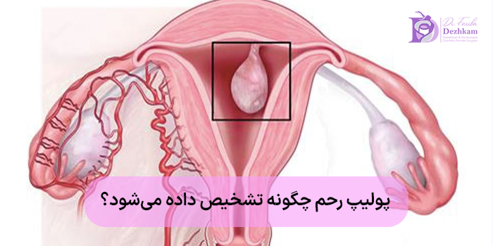 پولیپ رحم چگونه تشخیص داده میشود؟